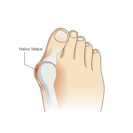 Achat pour soulager Hallux valgus